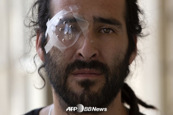 반정부 시위에 휘말려 눈을 다친 세사르 카료소씨. 칠레 산티아고 병원에서. ⓒCLAUDIO REYES / AFP / AFPBBNews